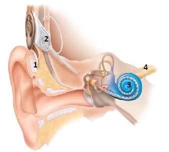 Cochlear implant systems patent case between the United States and Australia, Cochlear implant systems patent case , Cochlear implant systems patent ,
